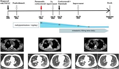 Case Report: Nintedanib for Pembrolizumab-Related Pneumonitis in a Patient With Non-Small Cell Lung Cancer